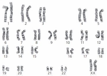 Síndrome de Down: um exemplo comum de variação cromossômica - inspiração 1