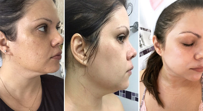 adapaleno antes e depois pele