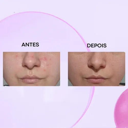 Adapaleno Antes E Depois