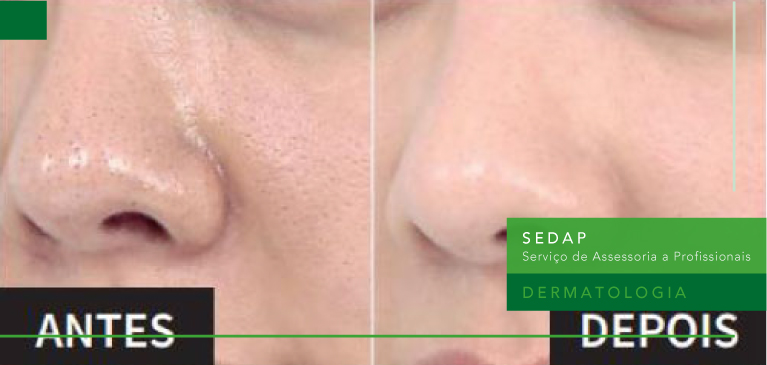 resultados adapaleno 3 meses