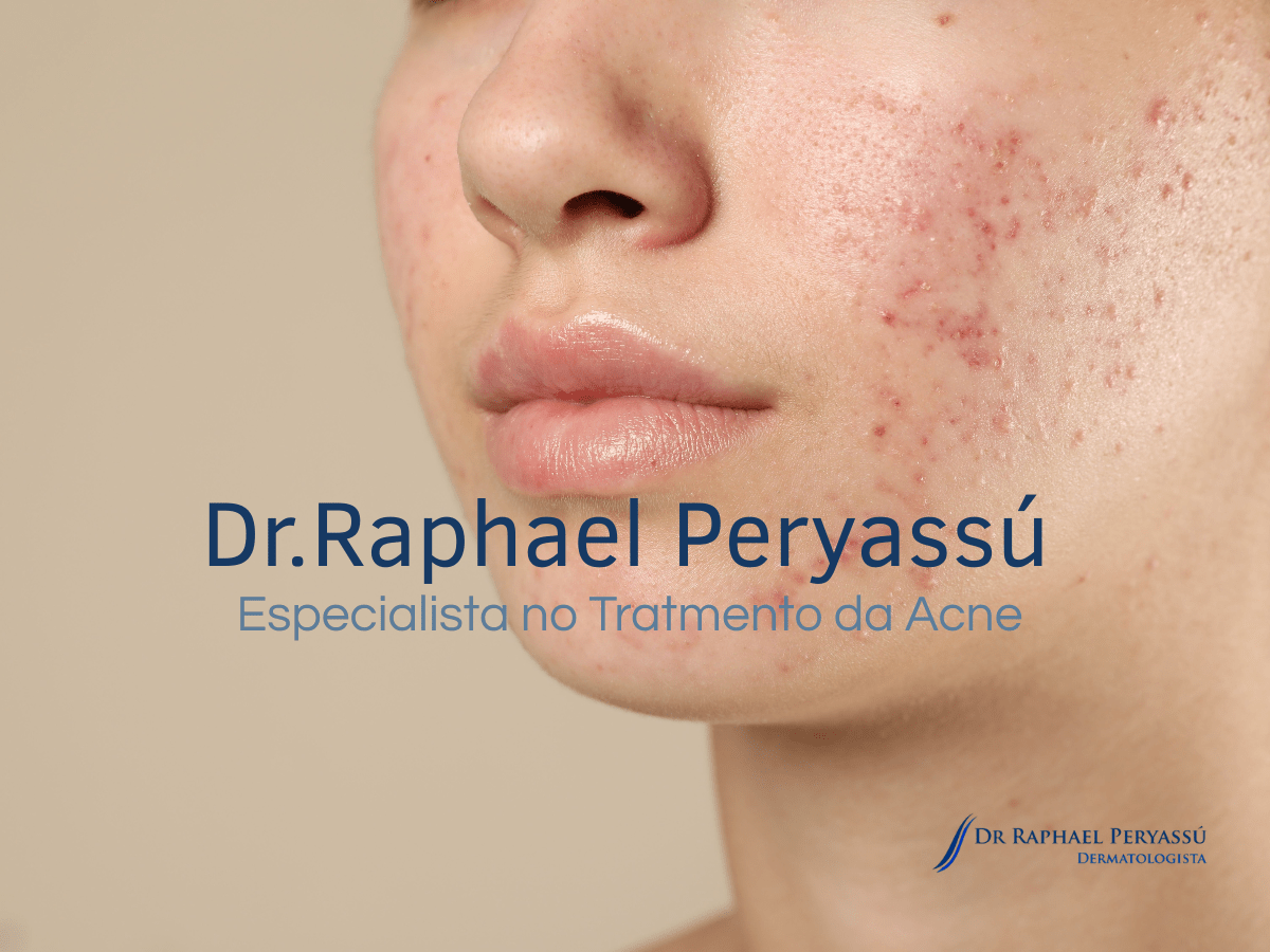 resultados adapaleno 3 meses