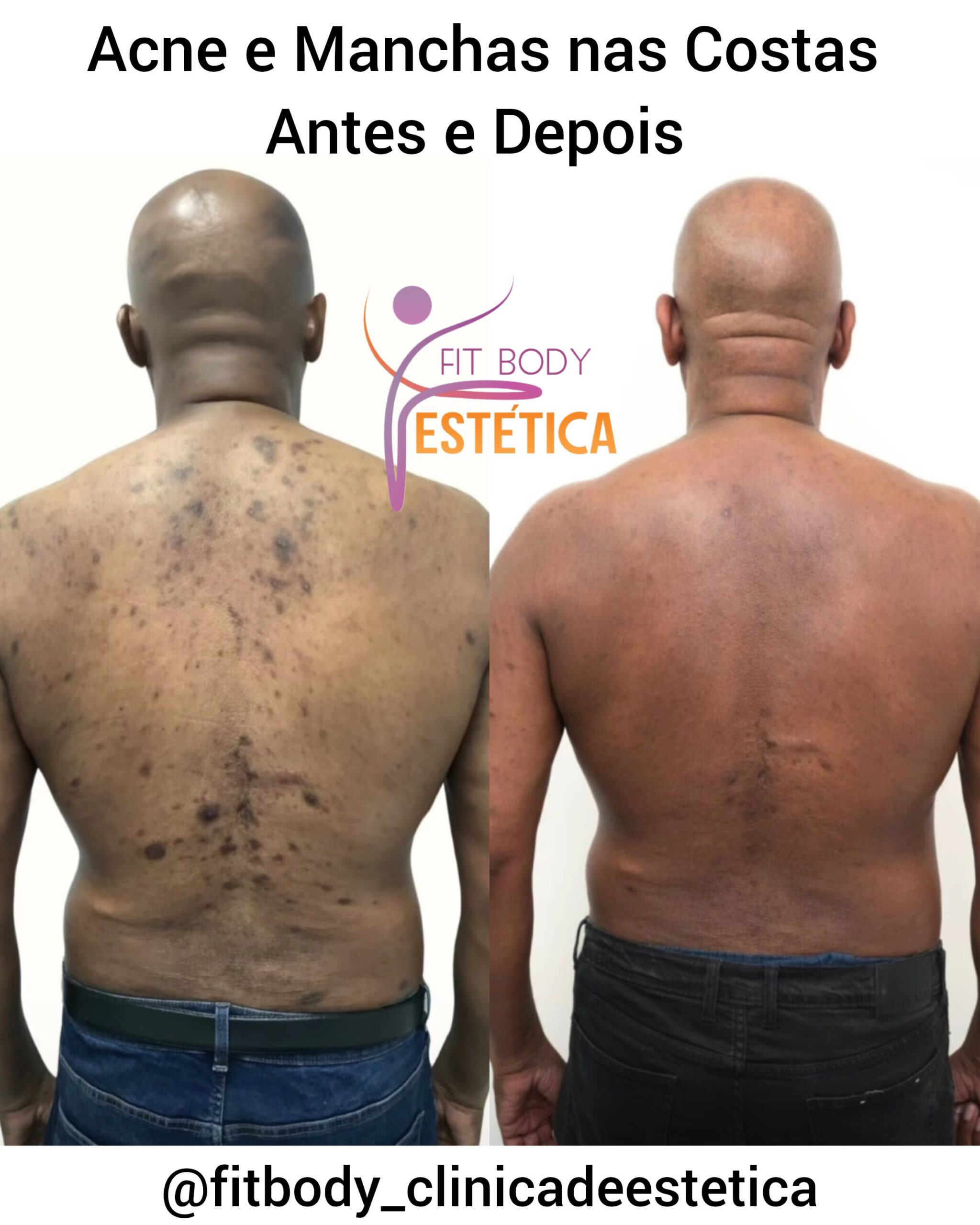 adapaleno para manchas escuras