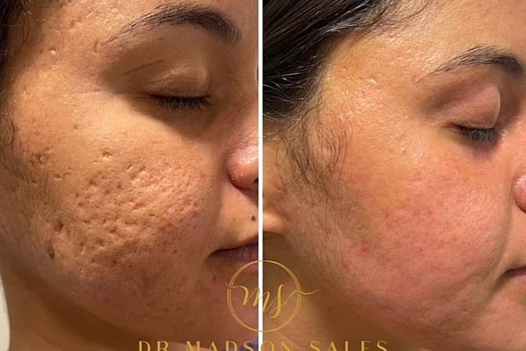 efeitos colaterais adapaleno pele seca