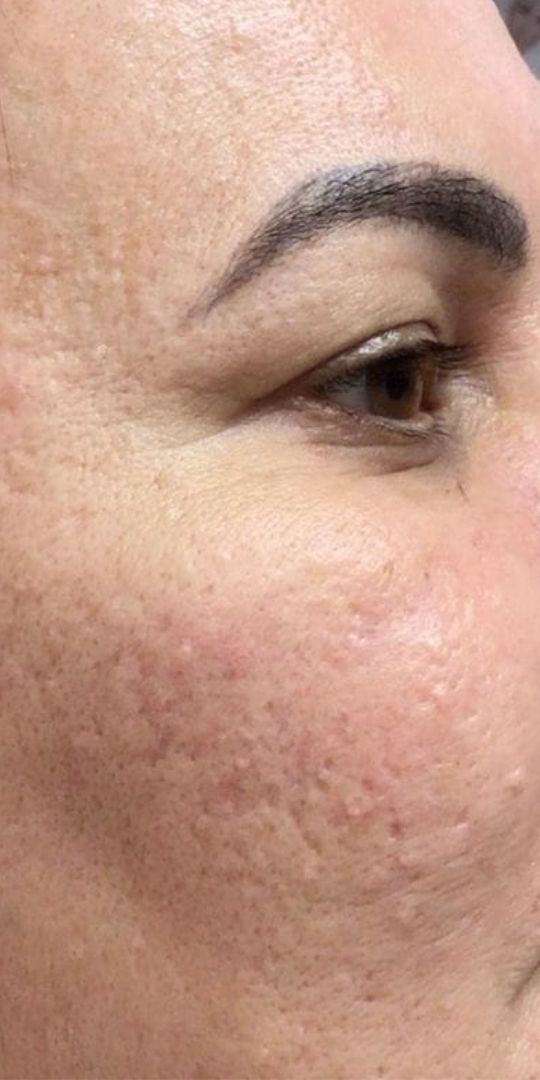 resultados adapaleno 3 meses