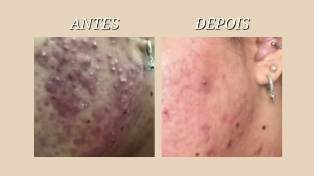 tratamento acne com adapaleno