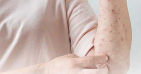 Doença Celíaca: Guia Completo de Sintomas, Diagnóstico e Tratamento