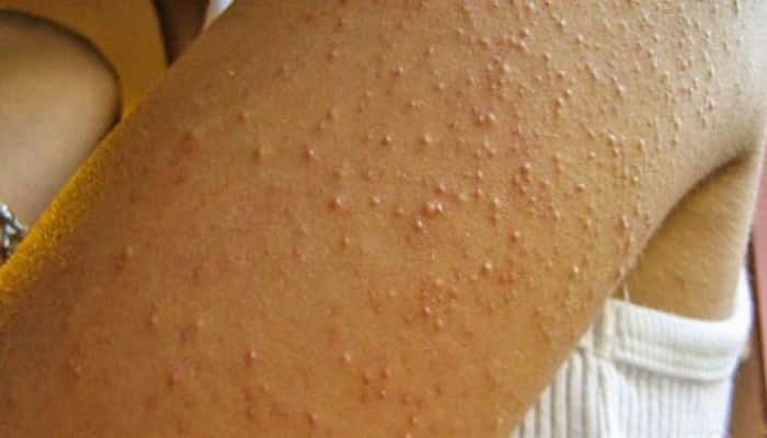 Alergia ao Trigo vs. Sensibilidade ao Glúten: Entenda as Diferenças Cruciais