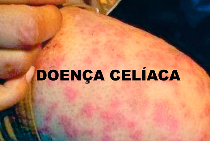 Alergia ao Trigo vs. Sensibilidade ao Glúten: Entenda as Diferenças Cruciais