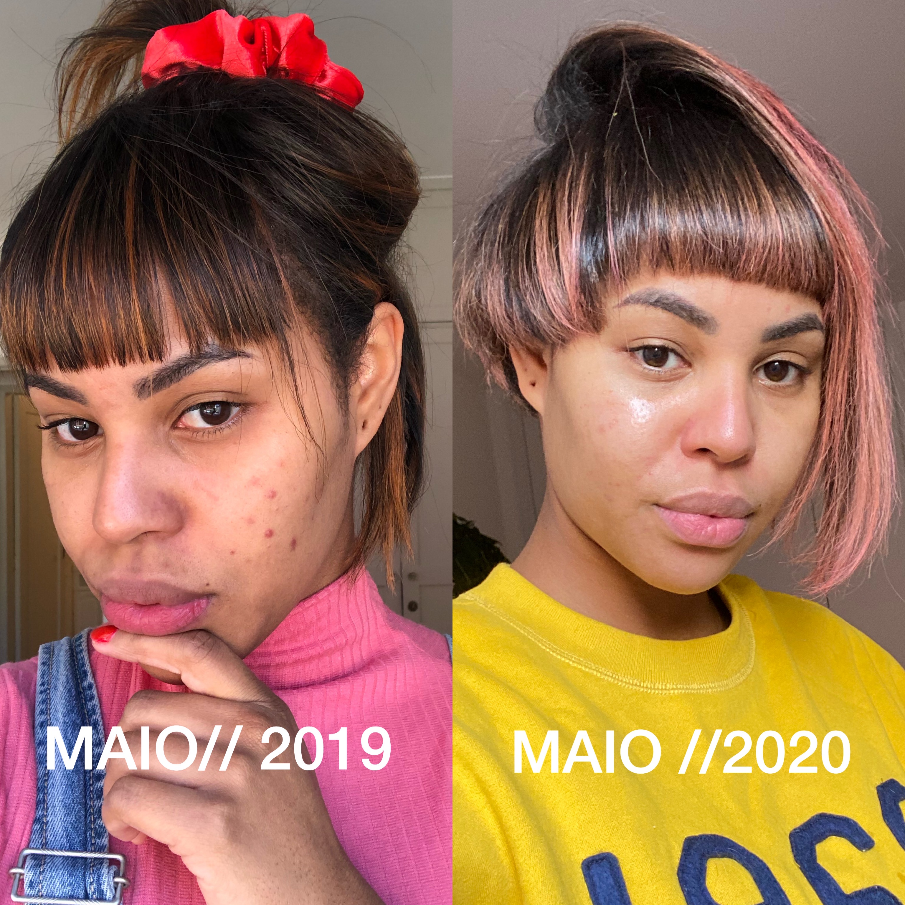 Anticoncepcional Para Pele Oleosa