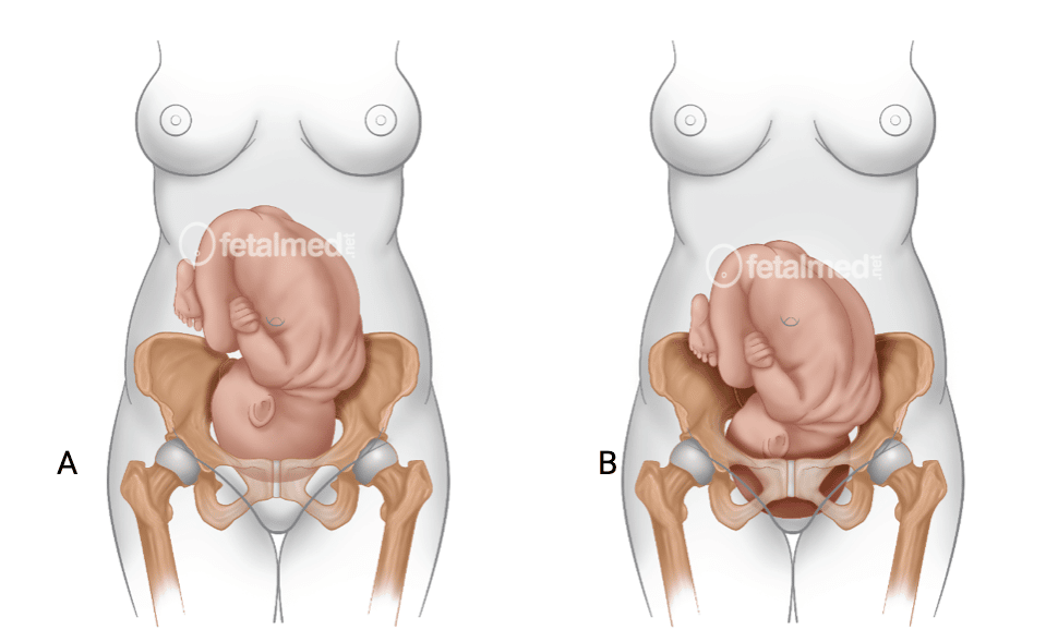 1. O que significa quando o bebê encaixa? 2. Sinais de que o bebê encaixou e o parto está próximo. 3. Bebê encaixado com 34 semanas: o que esperar? 4. Cuidados essenciais quando o bebê encaixa. 5. Diferença entre bebê encaixado em primigestas e multíparas.