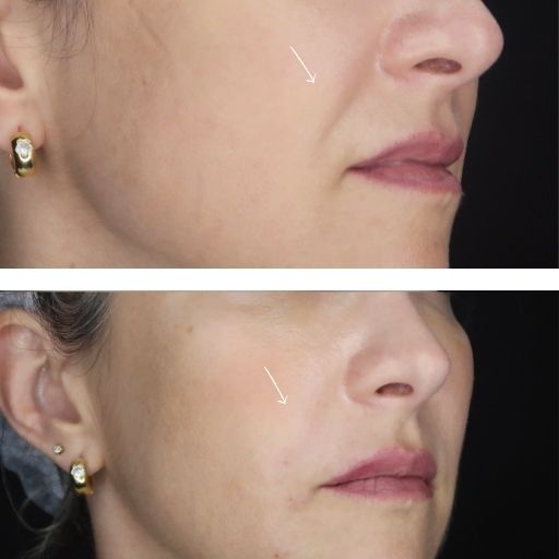 5 ideias de títulos:
1. Bigode Chinês: Entenda as Causas e os Melhores Tratamentos.
2. Sulco Nasolabial: Do Envelhecimento Natural aos Procedimentos Estéticos.
3. Como Suavizar o Bigode Chinês: Dicas de Cuidados em Casa e Profissionais.
4. Preenchimento do Bigode Chinês: Ácido Hialurônico vs. Bioestimuladores.
5. Prevenção e Tratamento do Bigode Chinês: Um Guia Completo.