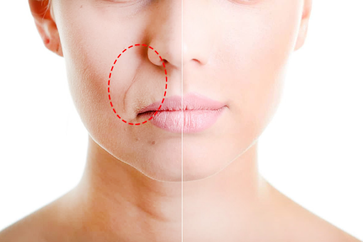 5 ideias de títulos:
1. Bigode Chinês: Entenda as Causas e os Melhores Tratamentos.
2. Sulco Nasolabial: Do Envelhecimento Natural aos Procedimentos Estéticos.
3. Como Suavizar o Bigode Chinês: Dicas de Cuidados em Casa e Profissionais.
4. Preenchimento do Bigode Chinês: Ácido Hialurônico vs. Bioestimuladores.
5. Prevenção e Tratamento do Bigode Chinês: Um Guia Completo.