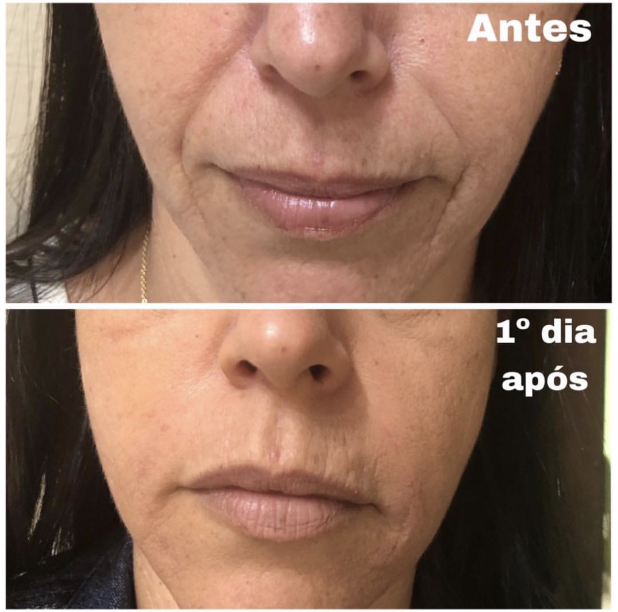 sulco nasolabial em adolescentes