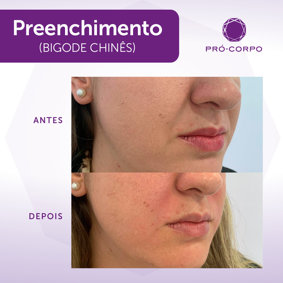 bioestimulador para sulco nasogeniano