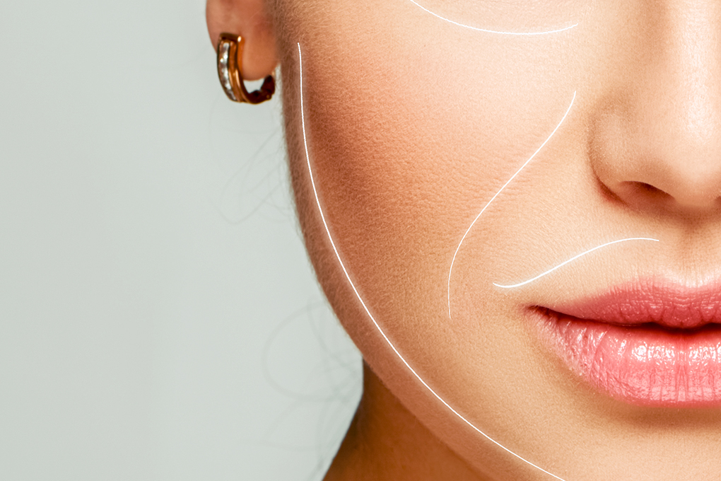 ultrassom microfocado para linhas faciais