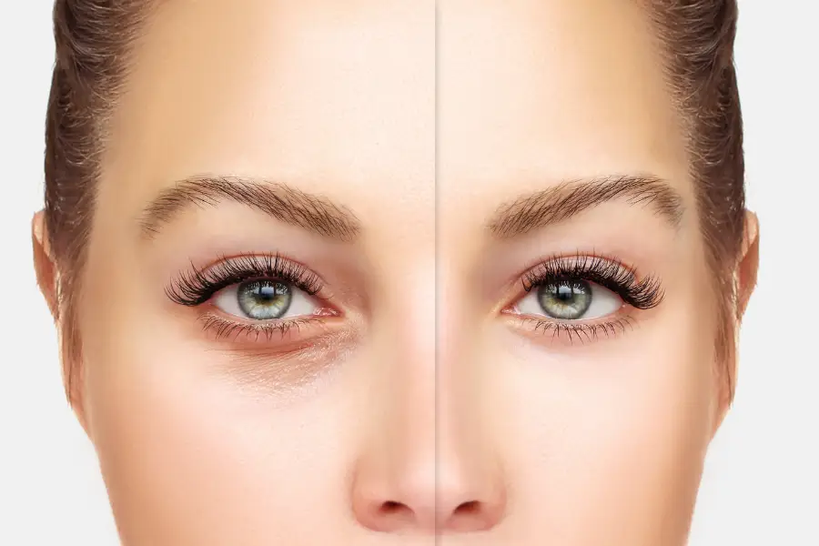 Receitas Caseiras para Desinchar os Olhos Pela Manhã