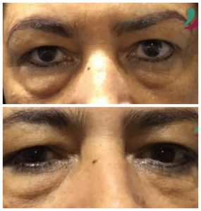 Como Prevenir Bolsas nos Olhos: Dicas Essenciais de Hábitos e Cuidados