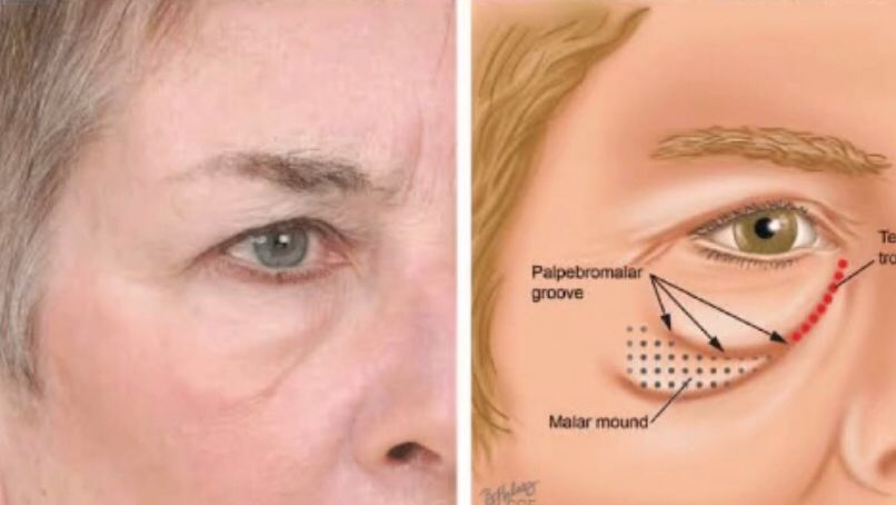 Receitas Caseiras para Desinchar os Olhos Pela Manhã