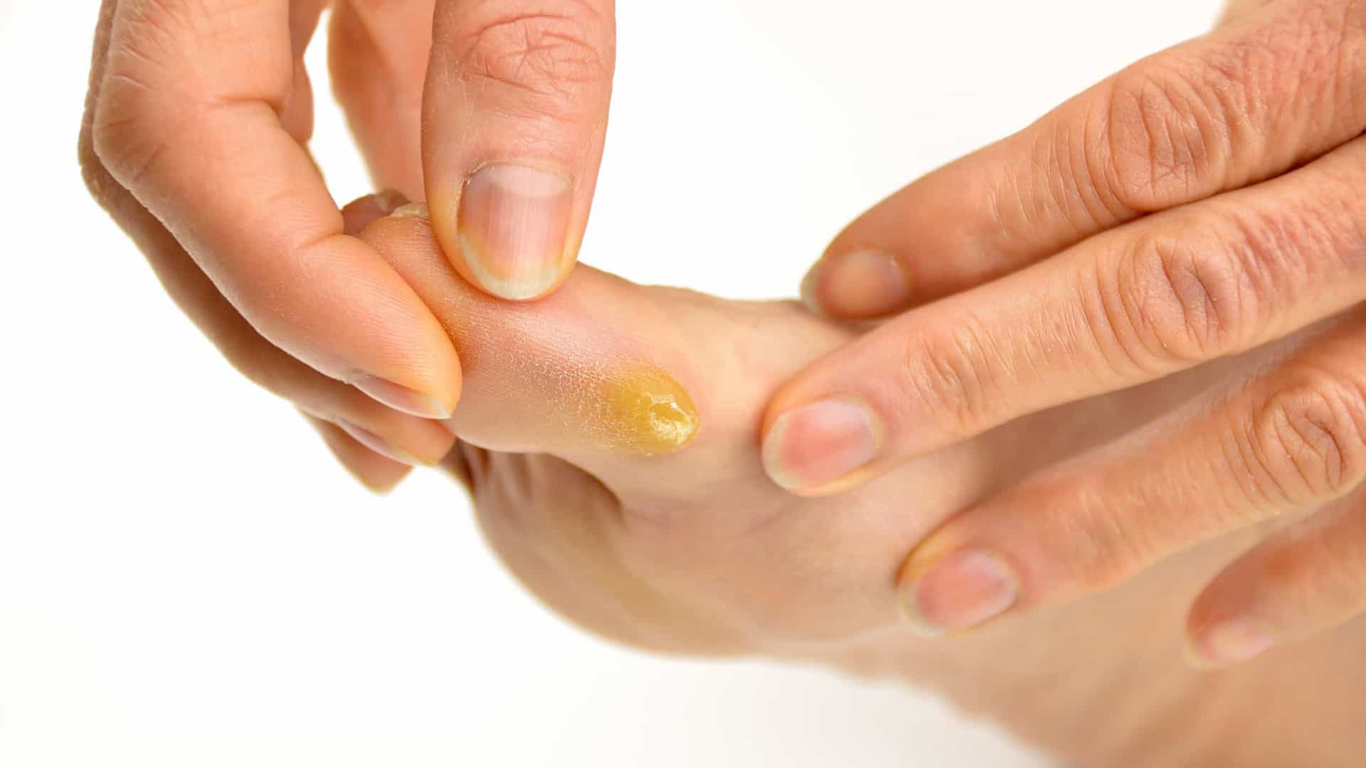 Calo O Que É Origem Tipos De Calo E Como Tratar