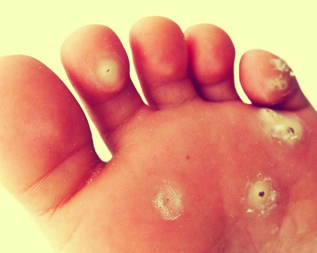 Guia Completo de Calçados para Evitar Calos e Bolhas