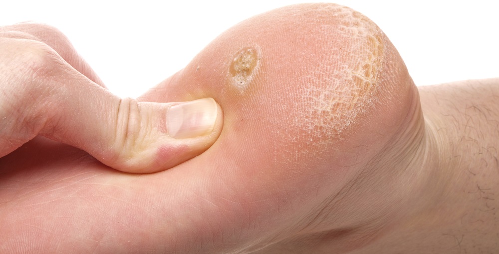 Os Melhores Cremes e Pomadas para Eliminar Calos Rapidamente