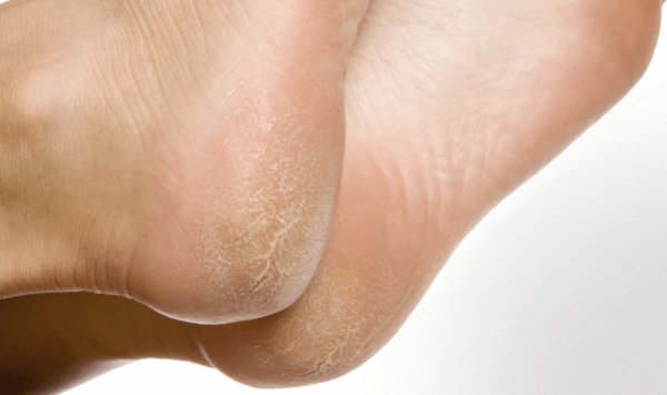 Calosidade e Verruga Plantar