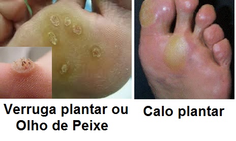 Remédios Caseiros e Naturais para Aliviar a Dor de Calos