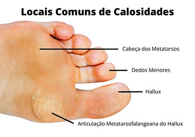 Calo O Que É Origem Tipos De Calo E Como Tratar