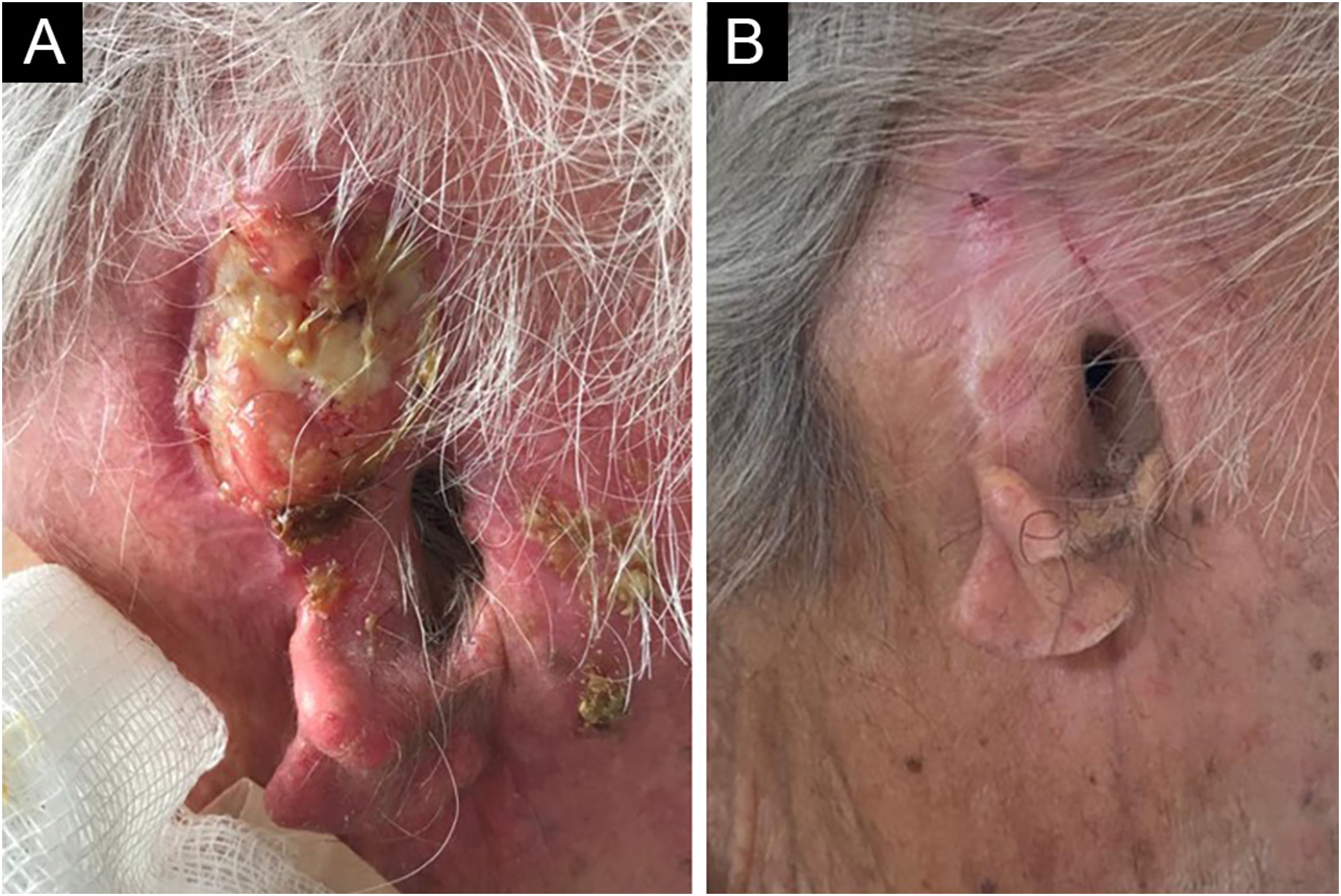 5 ideias de títulos:
1. Câncer de Ouvido: Sinais de Alerta que Você Não Pode Ignorar
2. Entendendo os Tipos de Tumores no Ouvido: Benignos e Malignos
3. Diagnóstico Precoce do Câncer de Orelha: A Importância da Ressonância Magnética
4. Prevenção do Câncer de Ouvido: Fatores de Risco e Cuidados Essenciais
5. O Que Fazer ao Identificar Sintomas de Câncer no Ouvido: Guia Completo