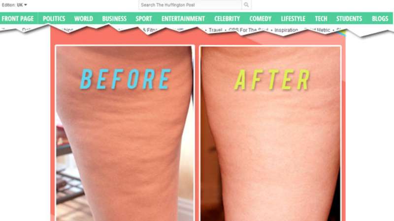 Celulite Como Diminuir