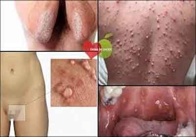 Sintomas de clamídia em homens: O que você precisa saber