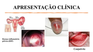 Como o SUS oferece tratamento gratuito para clamídia