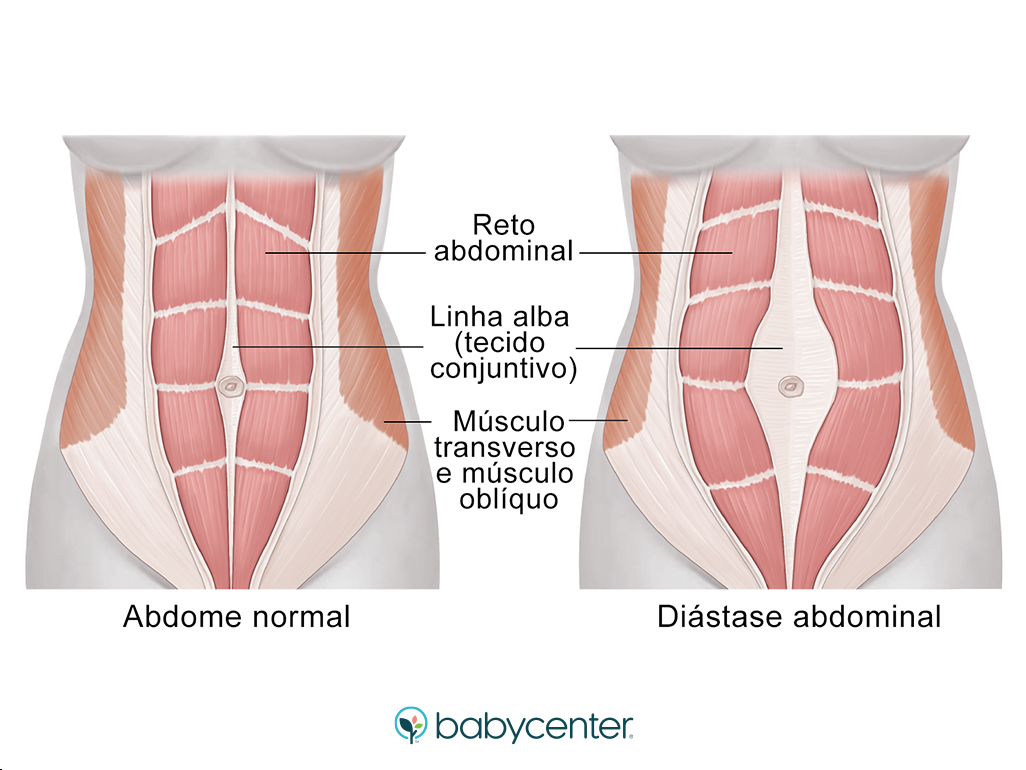5 ideias de títulos:
1. Guia Completo: Recuperando a Barriga Após Cesárea
2. Exercícios Seguros para Diástase e Flacidez Pós-Parto
3. Nutrição e Cuidados Essenciais para a Barriga Pós-Cesárea
4. Entendendo a 