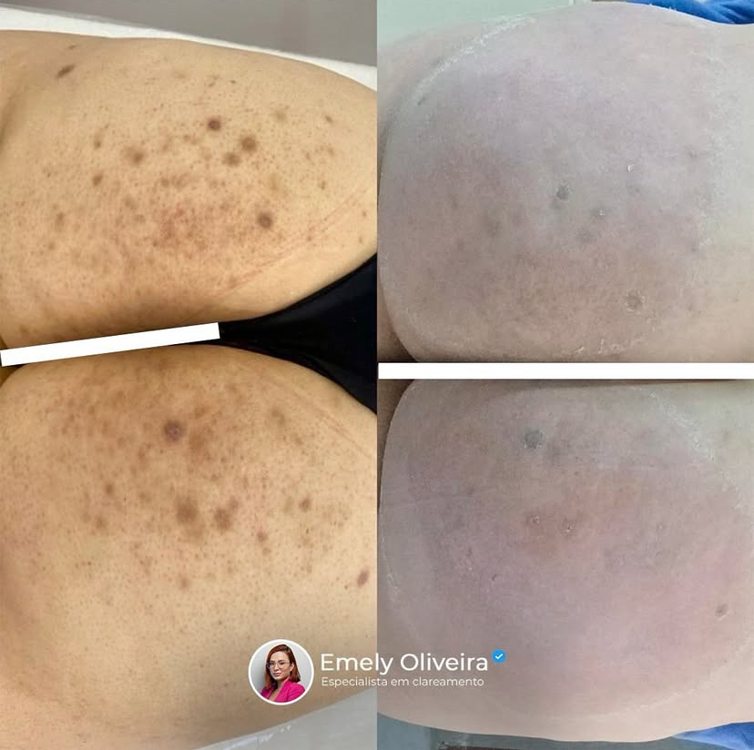 Como Tirar Manchas De Foliculite