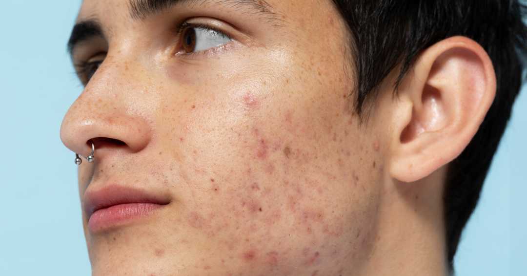 Guia Completo: Ácido Salicílico vs. Peróxido de Benzoíla para Acne Ativa