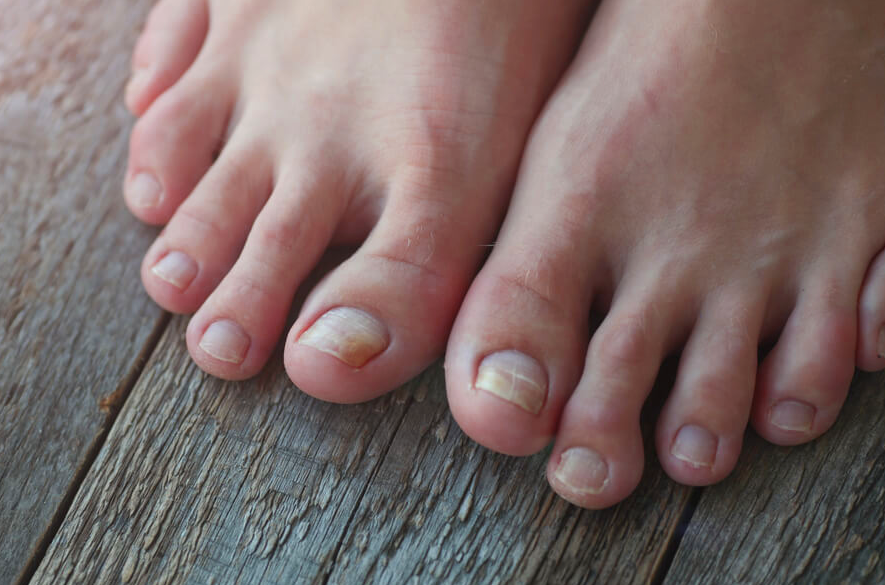 como tratar micose na unha do pé em casa