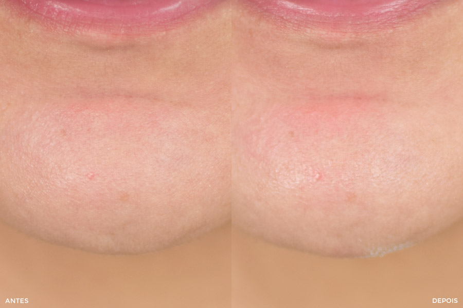 Guia Completo: Como Eliminar Cravos do Queixo de Vez