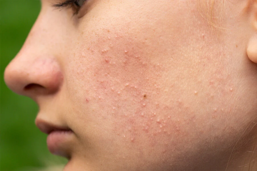 Os Melhores Ácidos para Tratar Cravos: Um Guia Detalhado