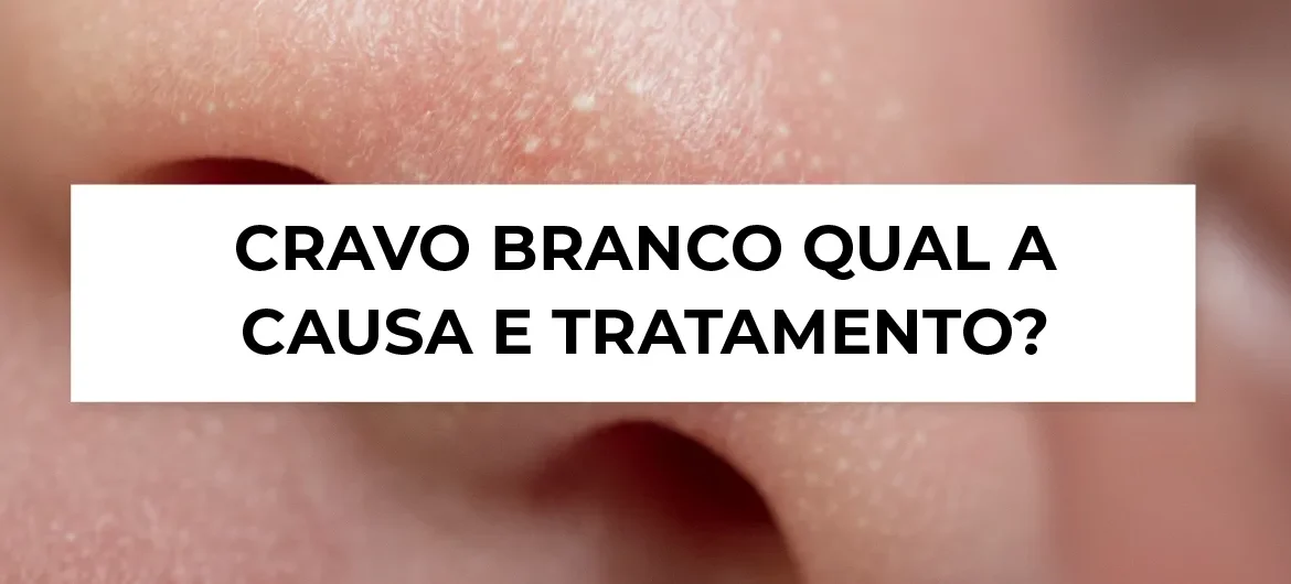 Mitos e Verdades sobre Espremer Cravos: O Que Você Precisa Saber