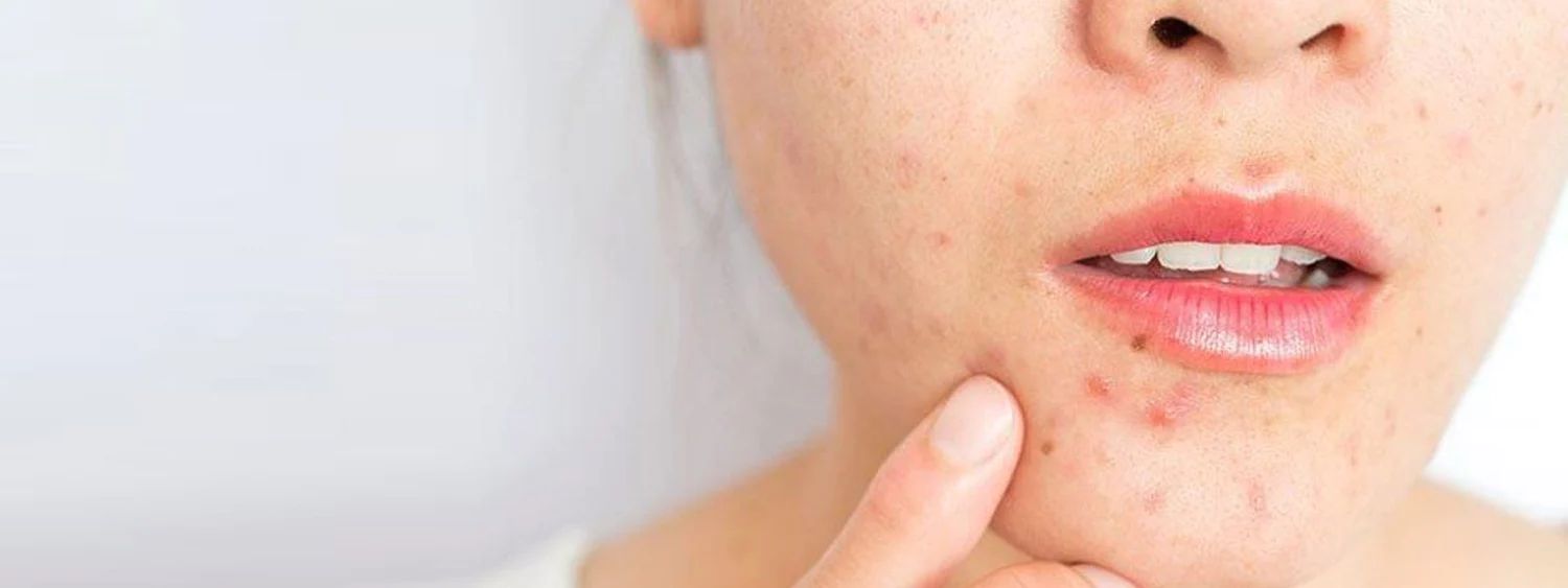 Guia Completo: Como Eliminar Cravos do Queixo de Vez