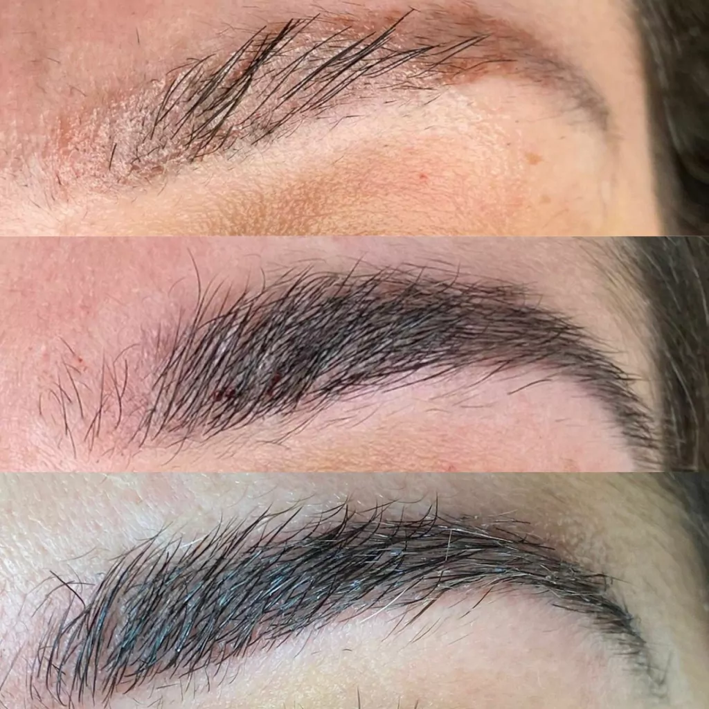 Minoxidil para Sobrancelhas: Guia Completo de Uso, Concentrações e Resultados