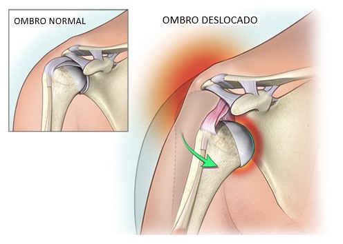 Sintomas de Luxação no Ombro: Como Identificar Imediatamente