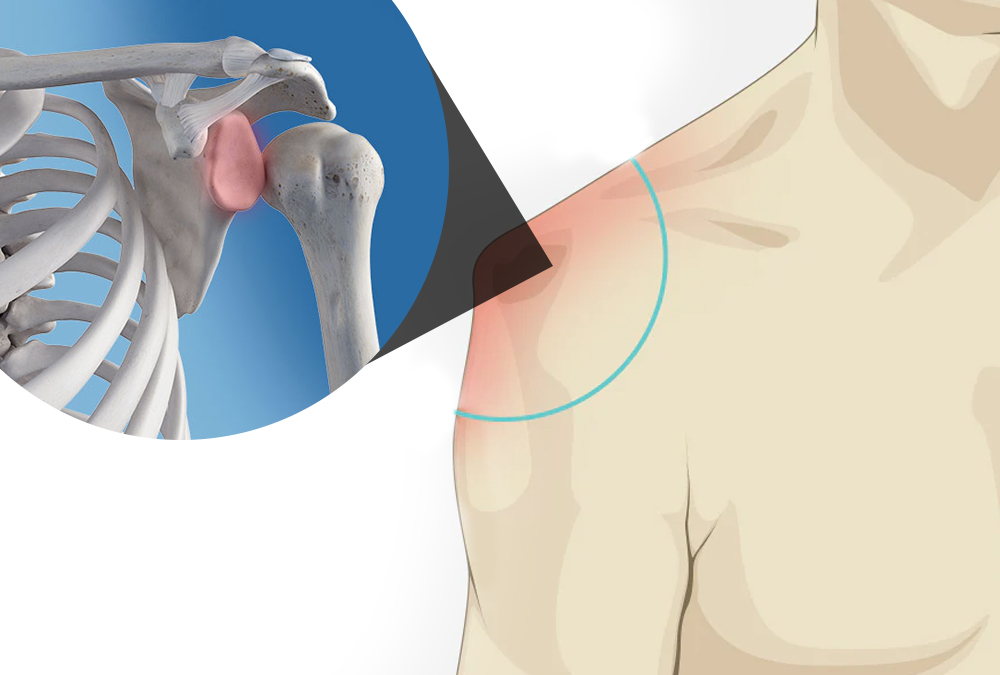 Quando a Cirurgia é Necessária para Luxação Recorrente do Ombro?