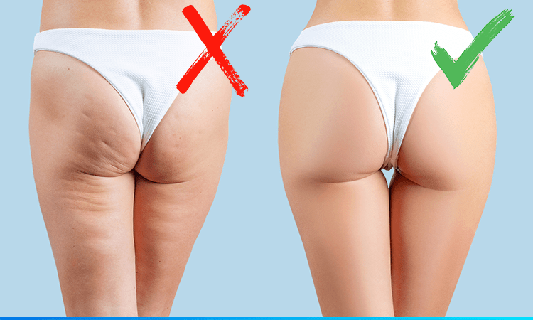 Dicas Para Acabar Com A Celulite