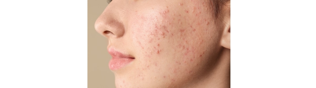 Como Evitar Manchas e Cicatrizes de Acne: Um Guia Essencial