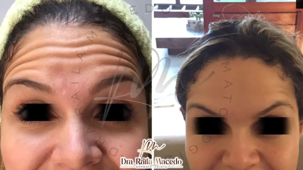 Botox ou Preenchimento: Qual o Melhor para Suas Rugas?