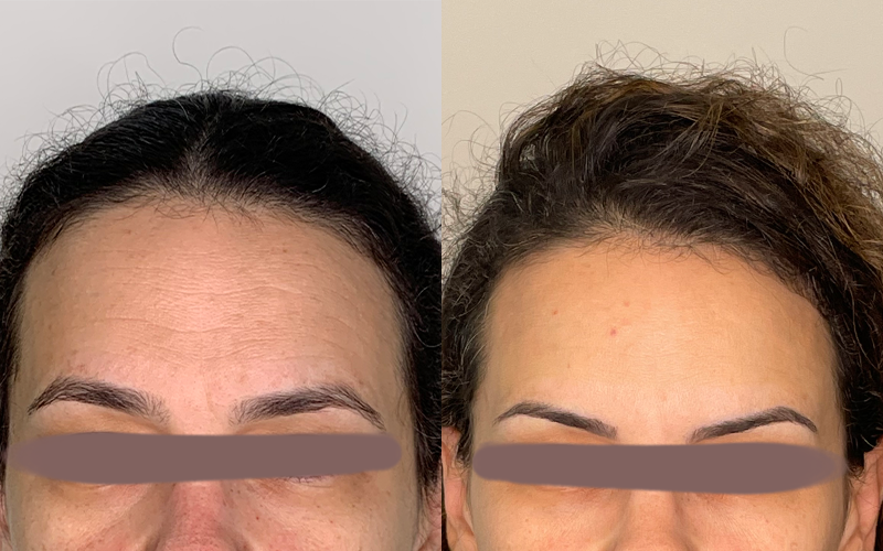 Tecnologias Avançadas para Rejuvenescimento Facial: Radiofrequência e Laser