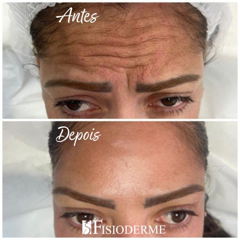 Vitamina C e Ácido Hialurônico