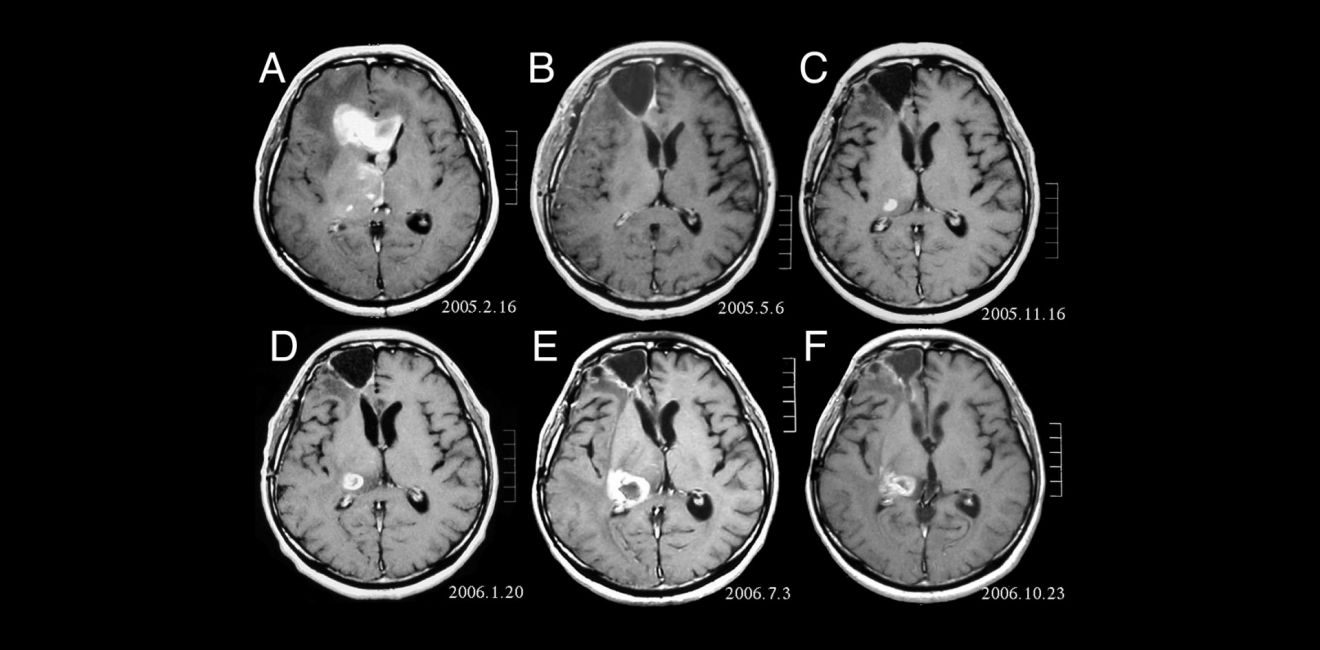 5 ideias de títulos:
1. Como as Drogas Afetam o Desenvolvimento da Esquizofrenia
2. Maconha e Esquizofrenia: Uma Análise Detalhada dos Riscos
3. Estimulantes e Alucinógenos: O Impacto na Saúde Mental
4. Diferenças Cruciais: Psicose Induzida por Substâncias vs. Esquizofrenia Crônica
5. O Papel do Álcool no Agravamento de Sintomas Psicóticos