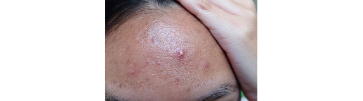 Espinhas Na Testa De Repente